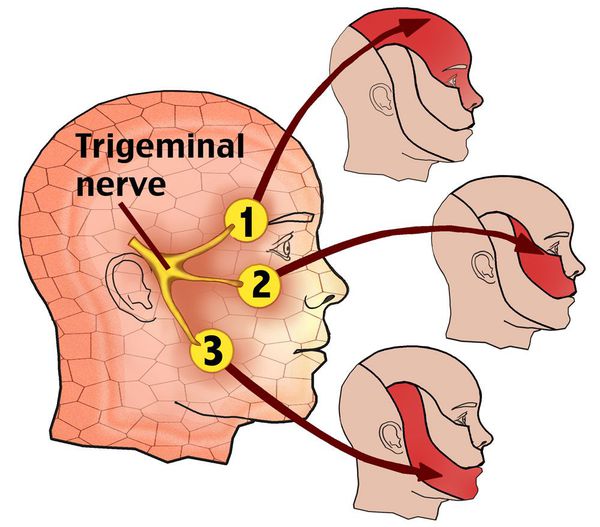 Может ли быть отек лица от невралгии тройничного нерва thumbnail