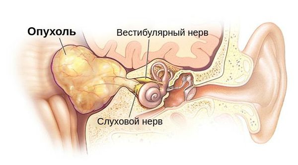 Опухоль, давящая на слуховой и вестибулярный нерв