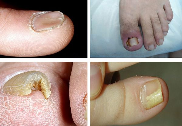 Как вылечить онихомикоз грибок ногтях thumbnail
