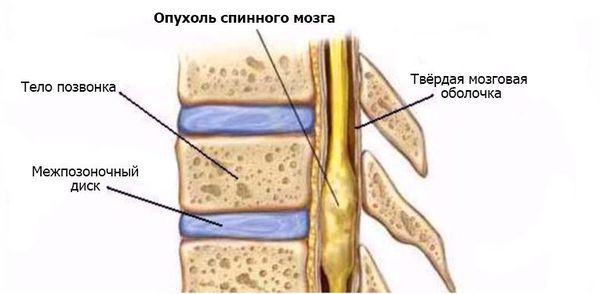 Опухоль спинного мозга шейного отдела позвоночника thumbnail
