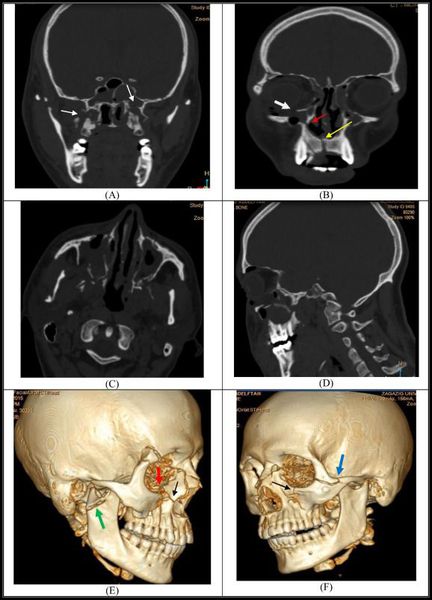 Компьютерная томография: перелом верхней челюсти