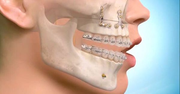 Переломы лицевых костей верхней челюсти thumbnail