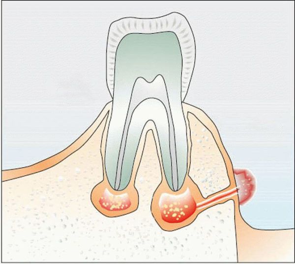Вывихи и переломы зубов переломы альвеолярного отростка thumbnail