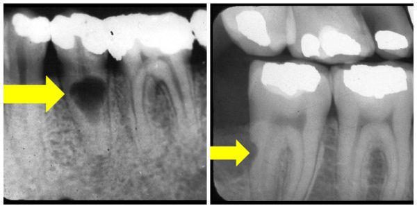 Перелом кости зуба симптомы thumbnail