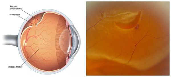 Периферическая дегенерация сетчатки глаза лечение thumbnail