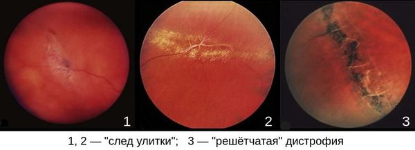 Периферическая дистрофия сетчатки глазное дно thumbnail