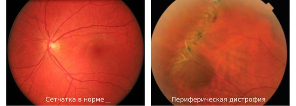 Сетчатка здорового глаза и сетчатка при периферической дистрофии