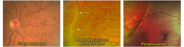 Периферическая дистрофия сетчатки глаза что это такое симптомы лечение thumbnail