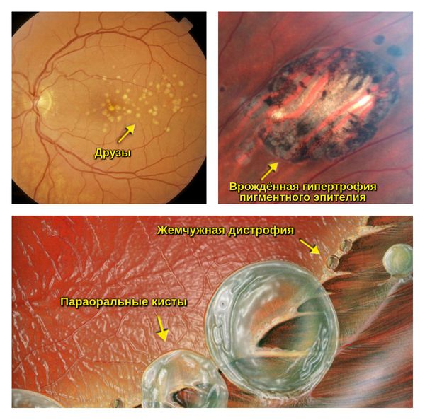 Периферическая витреохориоретинальная дегенерация сетчатки глаза thumbnail