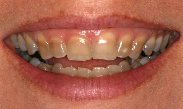 Пигментация зубов налет принципы лечения профилактика thumbnail
