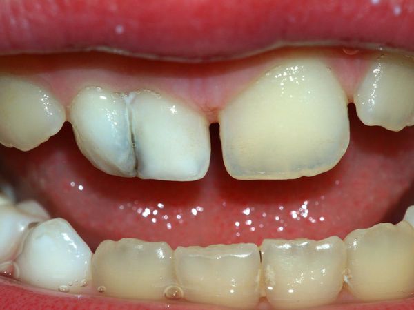 Потемнение молочного зуба после трещины