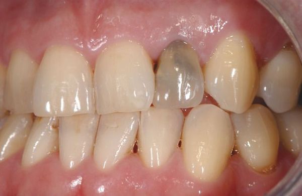 Потемнение зуба после лечения
