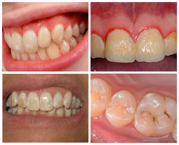 Симптомы пигментации зубов