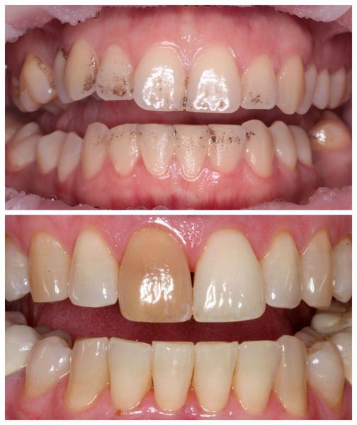 Точечная пигментация нескольких зубов и полное изменение оттенка одного зуба