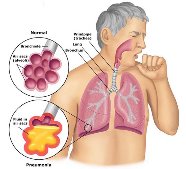 Пневмония клиническая картина диагностика лечение thumbnail
