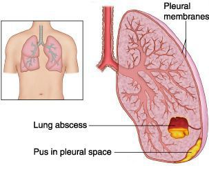 Классификация пневмоний по пути проникновения thumbnail
