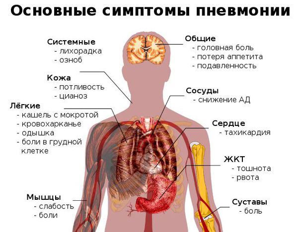 Симптомы причины пневмонии и профилактика thumbnail