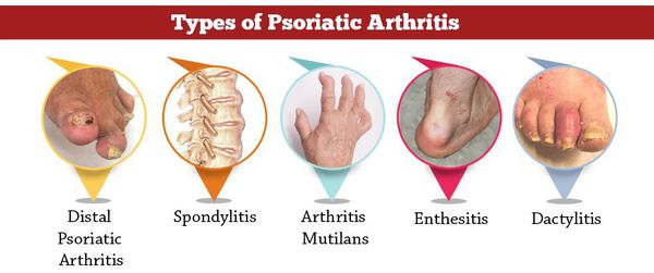 Виды псориатического артрита