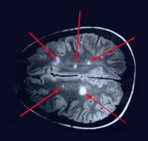 Мозжечковый синдром при рассеянном склерозе thumbnail