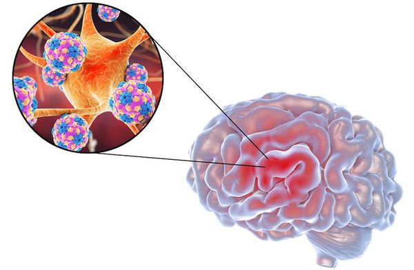 Возбудитель рассеянного склероза — нейтропный фильтрующийся вирус