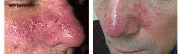 Нарушения микроциркуляции кожи лица при розацеа thumbnail