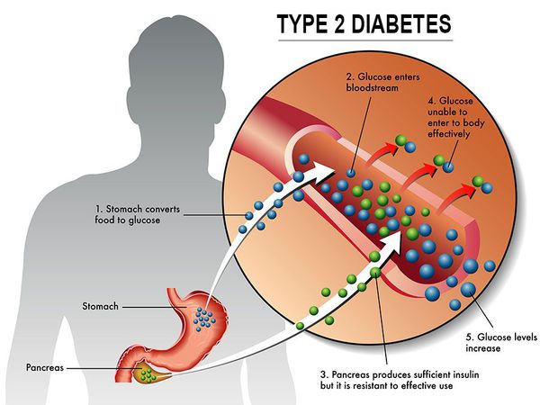 Нарушение липидного, белкового и углеводного обменов при диабете 2 типа