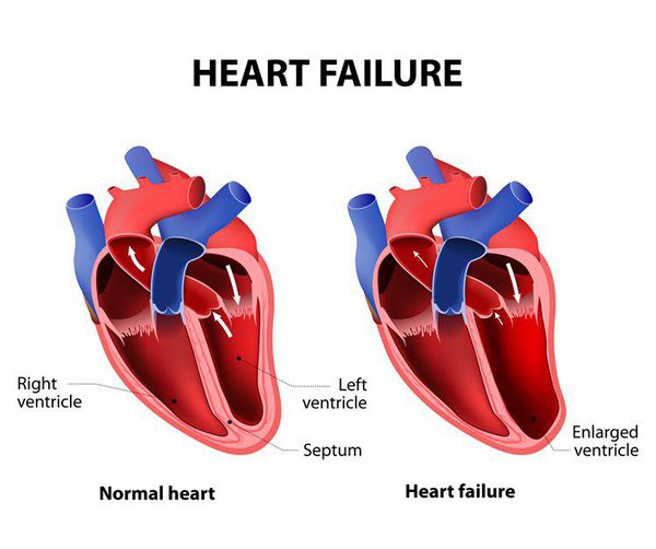 симптомы сердечной недостаточности