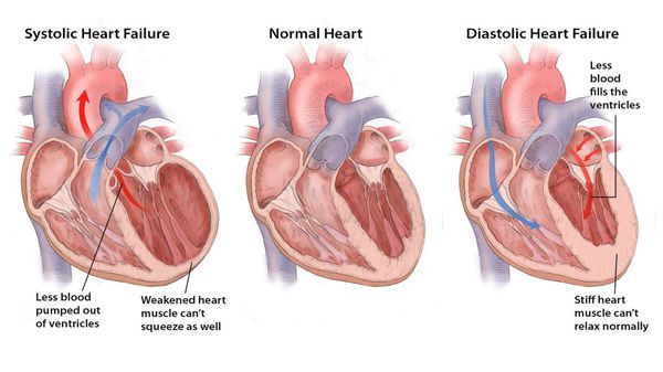 Причины вторичной сердечной недостаточности thumbnail