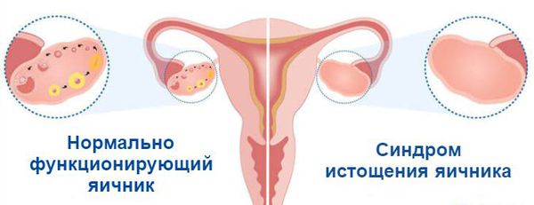 Синдром преждевременного истощения яичников с одним яичником thumbnail