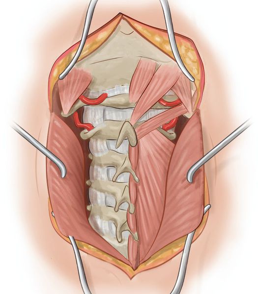 Мышцы, сдавливающие позвоночную артерию до и после выхода из канала