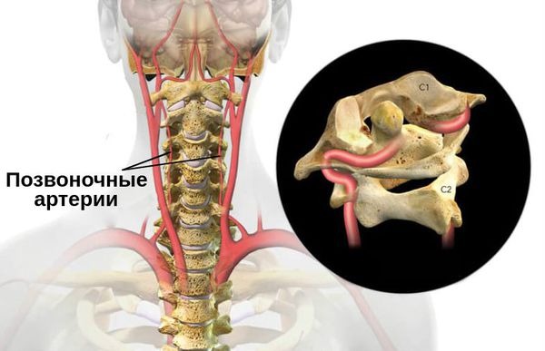 Синдром позвоночной артерии история болезни thumbnail