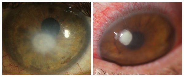 Синдром сухого глаза и слезотечение лечение thumbnail