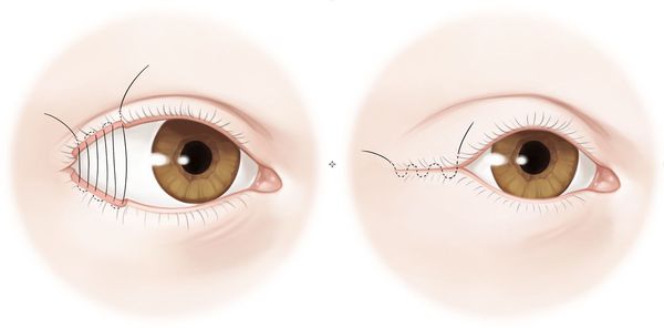 Разрыв слезной пленки глаза лечение thumbnail