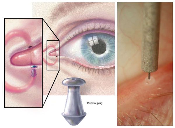 Какие симптомы синдрома сухого глаза thumbnail