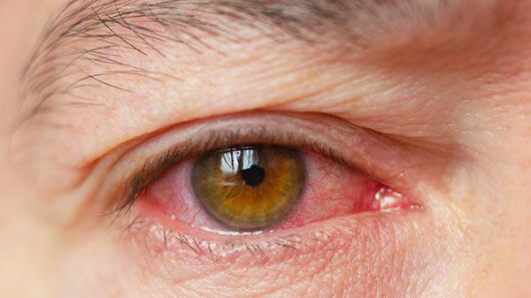 Раздражение при синдроме сухого глаза