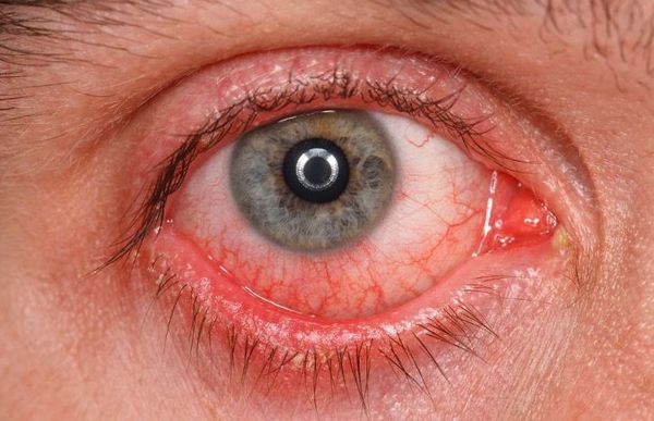 Лечение синдрома сухого глаза хирургическим путем thumbnail