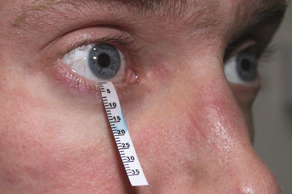 Синдром сухого глаза диагностика лечение thumbnail
