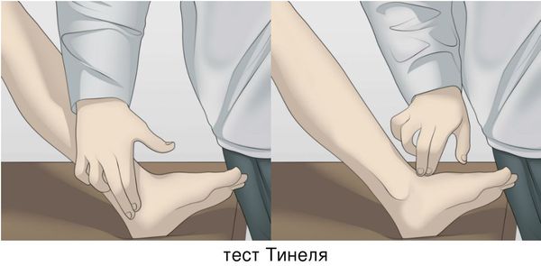 Синдром тарзального синуса голеностопного сустава thumbnail