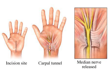 Синдром запястного канала при гипотиреозе thumbnail