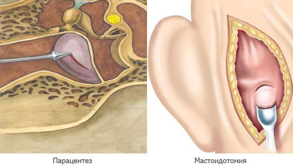 Отит среднего уха симптомы и лечение осложнения thumbnail