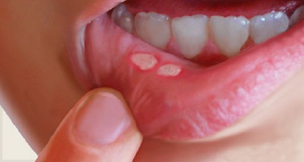 Воспаление слизистой оболочки полости рта