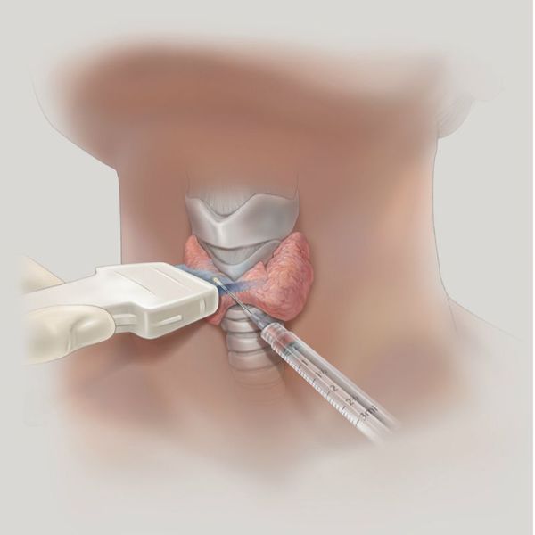 Тиреотоксикоз щитовидной железы симптомы у женщин лечение thumbnail