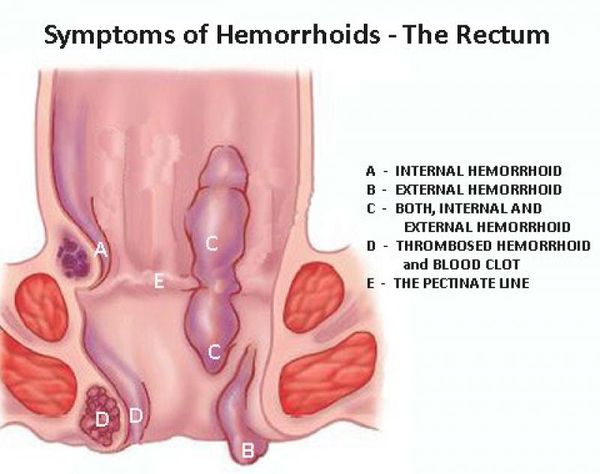 Как вылечить наружный тромбоз геморроидального узла thumbnail