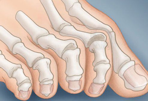 Лечение при вальгусных деформациях ног thumbnail