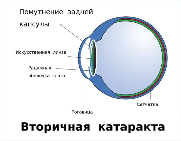 Вторичная катаракта противопоказания к thumbnail