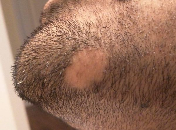 Точечное выпадение волос на голове thumbnail