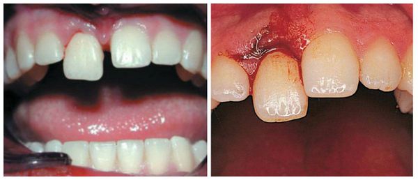 Вывих зуба лечение народными средствами thumbnail