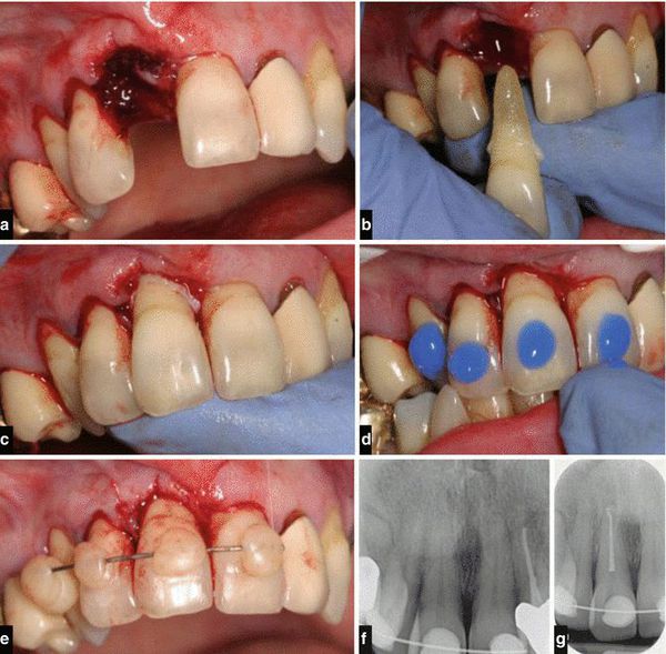 Реплантация и шинирование зуба при полном вывихе