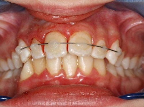 Вывих временных зубов лечение thumbnail