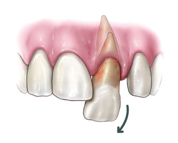 Вывих зуба с повреждением периодонта
